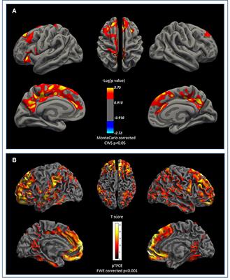 Quantification of Brain β-Amyloid Load in Parkinson's Disease With Mild Cognitive Impairment: A PET/MRI Study